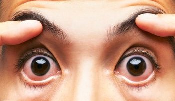 Kentut Bisa Bikin Mata Merah, Apakah Itu Benar?