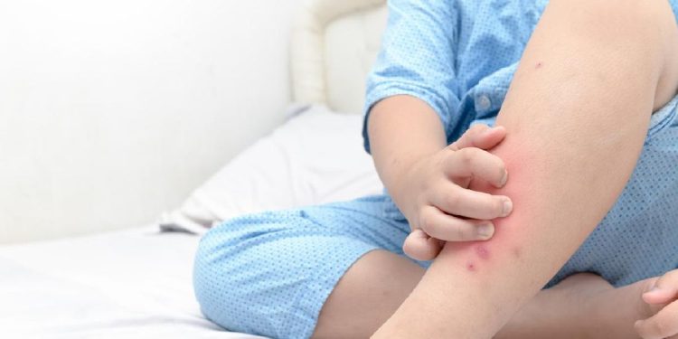 Memahami Perbedaan Gatal Umum dan Gatal Akibat Diabetes yang Perlu Diwaspadai