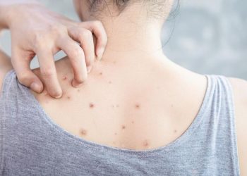 Jerawat Punggung Tak Hilang, Coba 8 Solusi untuk Mengatasinya