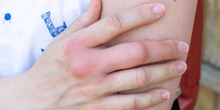 5 Tanda Kerusakan Ginjal yang Terlihat di Kulit yang Harus Diwaspadai