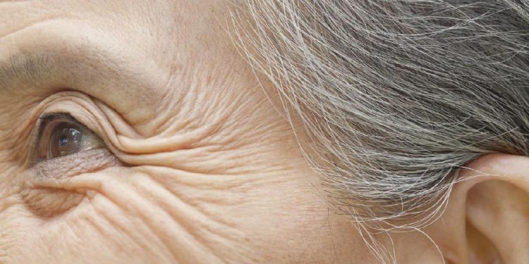 7 Penyebab Keriput di Bawah Mata yang Membuat Wajah Terlihat Tua